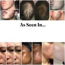 ديرما رول لفتح مسامات الجلد