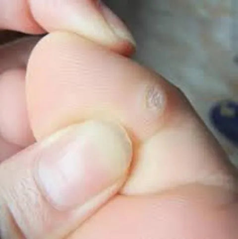 لصقات مسامير اللحم عدد 5 ضمادات طبية لعلاج جروح القدم